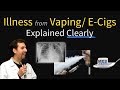 Vaping / E-Cigarette Lung Failure, Illness, Disease Outbreak