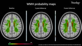 Video 1 Nonlinear temporal dynamics of cerebral small vessel disease