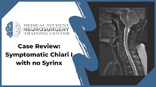 Case Review: Symptomatic Chiari I with no Syrinx