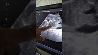 19 week scan.2nd baby. it's baby boy💙.සති 19දී කරපු ස්කෑන් එක,ගොඩක් සතුටු වුණ දවසක්.