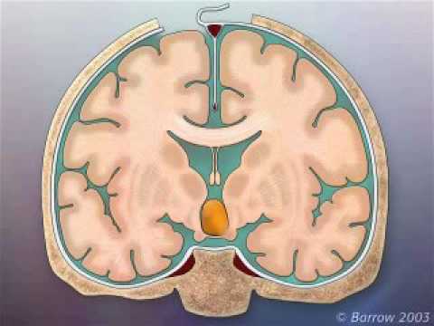 Transcallosal Tc Surgical Approach To Hypothalamic Hamartomas Youtube