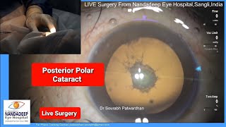 Posterior Polar Cataract  Low IOP phaco Dr Sourabh D Patwardhan demonstrates live Phaco surgery.