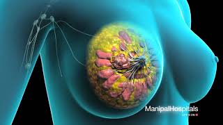 Surgical Procedure For Breast Removal | Breast Surgery Hospital In India - Manipal Hospital