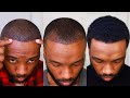 Hair Transplant Month 1-6