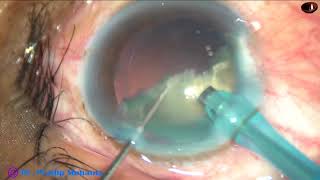 Phacoemulsification of an mature non-intumescent cataract - Pradip Mohanta