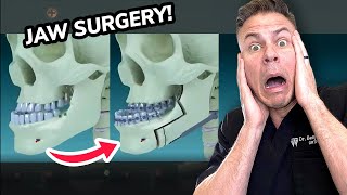 You Won't Believe What REALLY Happens In Jaw Surgery!