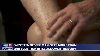 West Tennessee man gets more than 200 seed tick bites all over his body