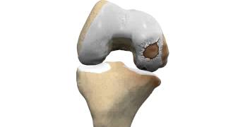 Medial Compartment Knee Osteoarthritis