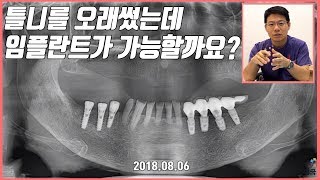 [대전 투명교정, 대전 임플란트]틀니를 오래 썼는데 임플란트가 가능할까요?