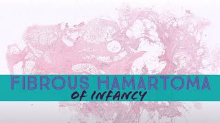 Fibrous hamartoma of infancy (dermpath dermatology dermatopathology soft tissue pathology)