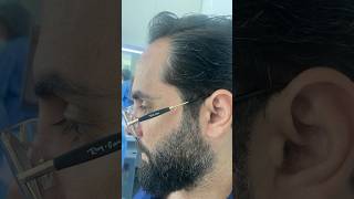 نتيجة زراعتي الشعر بعد 6 أشهر - تجربت المخرج طارق زياد عائشه مع زراعة الشعر