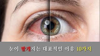 안과: 눈이 빨개지는 대표적인 이유 10가지 (2번째)