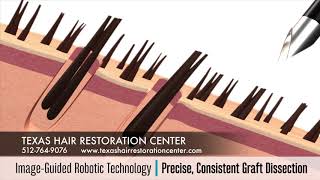 ARTAS iX Robotic Hair Restoration Austin Hair Transplant