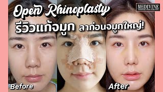 รีวิวแก้จมูกชมพู่ ปลายจมูกใหญ่ให้เรียวเล็ก แก้จมูกโอเพ่น เทคนิค Nose Reconstruction กับหมอฟู่ เศวต