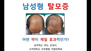 [ 남성형 탈모증 (Androgenetic Alopecia) 어떤 약이 제일 효과적인가? ]