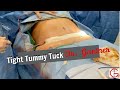 Tight Tummy Tuck | Liposuction| Mommy Makeover | Before & After surgery| Dr. Gartner Plastic surgeon