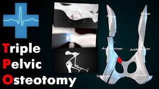 Тройная остеотомия таза/Triple Pelvic Osteotomy