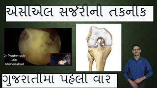 ACL Surgery Demonstrated in Gujrati. એસીએલ સર્જરી કરવાની મહિતી