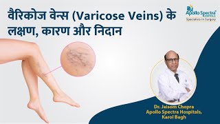 वैरिकोज वेन्स (Varicose Veins) के लक्षण, कारण और निदान