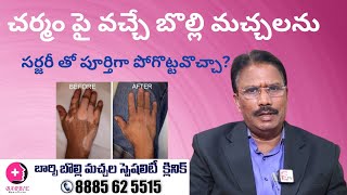 చర్మం పై వచ్చే బొల్లి మచ్చలు మీ ఆత్మవిశ్వాసాన్ని తగ్గిస్తున్నాయా? | #BarbieSkinandLaserClinic