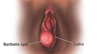 ជំងឺដុំគីសទ្វាមាស (Bartholin cyst)