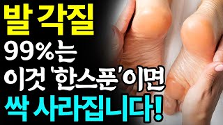 집에서 발 뒤꿈치 각질 없애는 방법 3가지 총정리! 천연 각질제거제인 '이것'만 하면 두껍고 거칠어진 발바닥이 보들보들 매끈해집니다! I 발각질 제거하는법, 각화형무좀 I