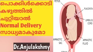 Umbilical Cord Around Neck/Malayalam/Dr.Anjulakshmy