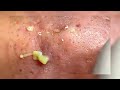 hot new video blackhead getting rid of acne on the noseh 2022