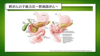 徳島大学病院「TVいきいきらいふ」第76回膵がん② ～膵がんの分類と集学的治療について～