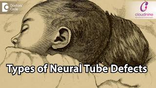 What are the types of Neural Tube Defects? - Dr.Tanushri Mukherjee of Cloudnine Hospitals