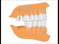 Интрузия одиночного моляра якорной пластиной pm 01 05 или pm 01 06