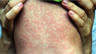 Original Marion County measles exposure sites deemed safe