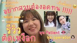 [Story Time]​ รีวิวตัดเหงือก Esthetic Crown Lengthening​🦷ทั้งมุมคนทำและคนไข้ในคนเดียวกัน! | FernnCL