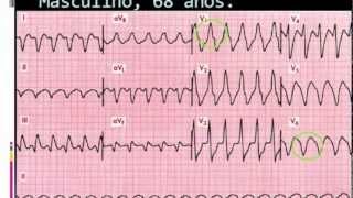 www.ecgepm.com: Video aula de eletrocardiograma baseada em casos clínicos