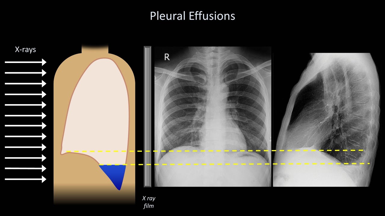 Differential Diagnosis: Pleural Effusion Differential Diagnosis