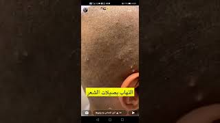 التهاب بصيلات الشعر (سناب الدكتور أنور الحمادي)