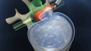 Full-endoscopic microdiscectomy for herniated disc, transforaminal approach