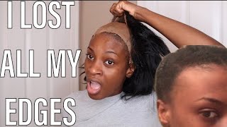 How To Remove Lace Wigs Gone Wrong | Lost All My Edges | Never Again