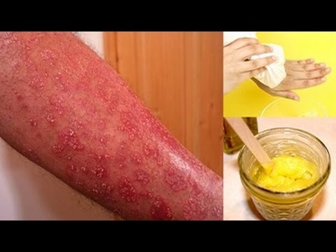 How to Get Rid Of Eczema Fast - Eczema Treatment How to Get Rid Of Eczema Fast - Eczema Treatment