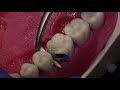 filling a cavity between teeth class ii composite resin procedure to treat an interproximal cavity