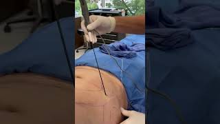 SmartLipo Procedure on Upper and Lower Abdomen, Flanks, and Chest