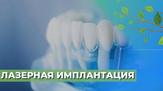 Лазерная имплантация зубов ☘️