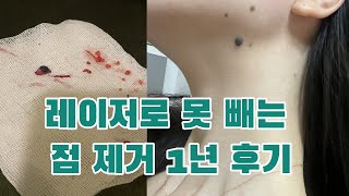 뿌리깊고 털있는 돌출점 제거 1년 후 영상❕