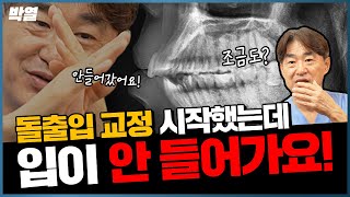 돌출입교정, 이거 알고 하면 훨씬 마음편해집니다!