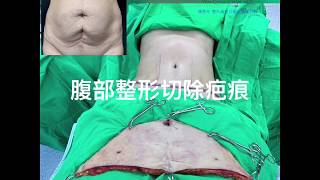 垂直剖腹產疤痕腹部拉皮矯正-陳彥州醫師