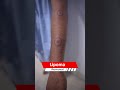 lipoma lipoma removal multipal lipoma removal short shortvideo