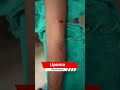 lipoma lipoma removal multipal lipoma removal short shortvideo