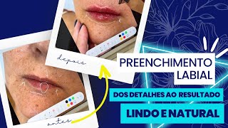 PREENCHIMENTO LABIAL. Mais um resultado incrível!