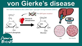 Von Gierke disease | Type I glycogen storage disease (GSD I) | Glycogen metabolism