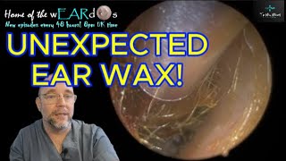 UNEXPECTED EAR WAX! 264 #ear #earwax #earwaxremoval #earcleaning #fyp  #asmr #asmrearwax #satisfying